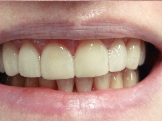 After: bright aligned smile