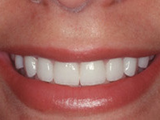 After: whitened even smile