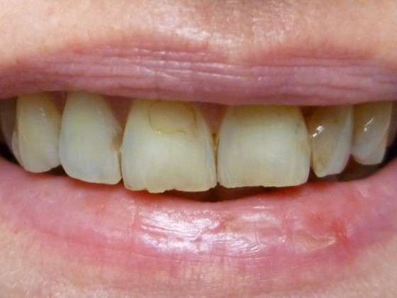 Before: stained gapped teeth