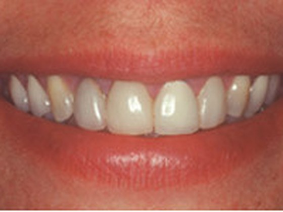 Before: missing and damaged teeth