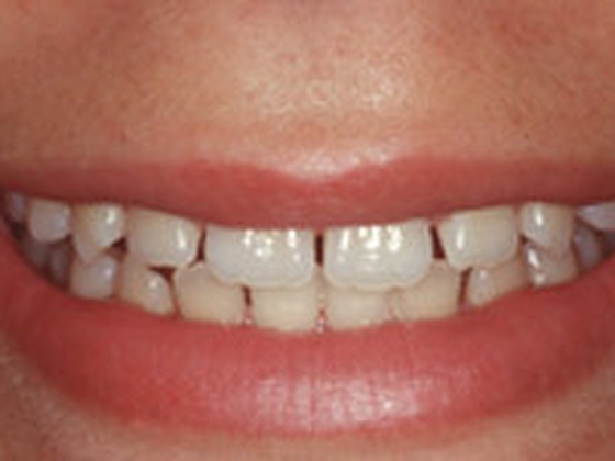 Before: yellowed teeth